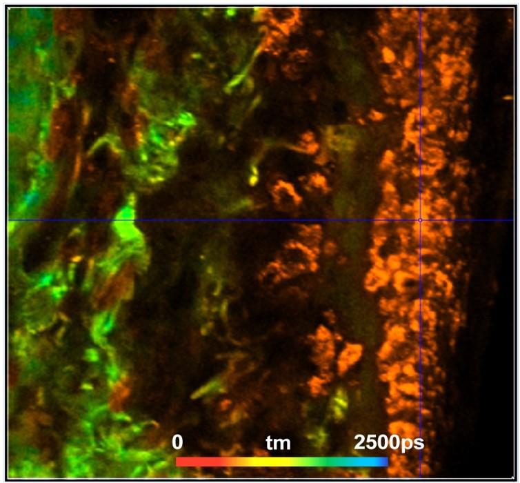 恶性黑色素瘤的超快荧光寿命衰减插图 恶性黑色素瘤的超快荧光寿命衰减插图